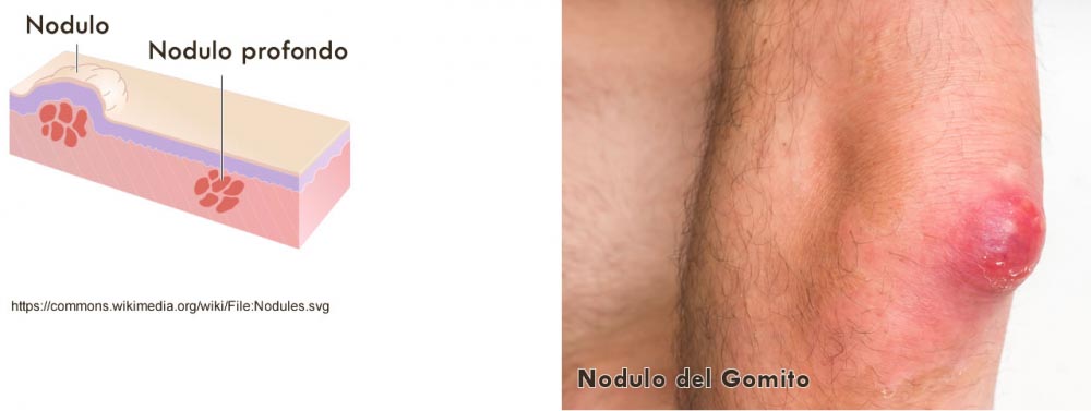 nodulo