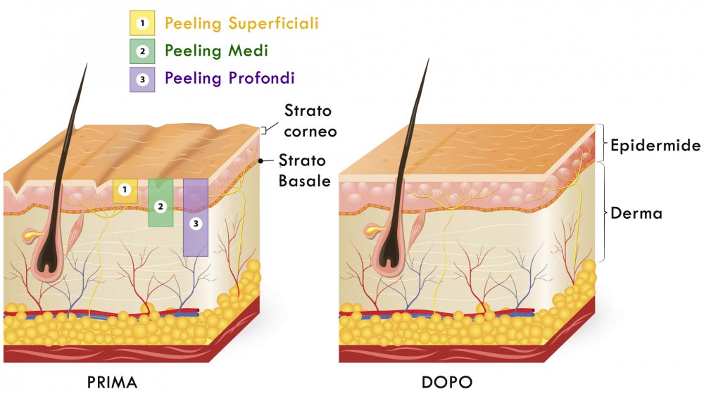 Tipi di Peeling