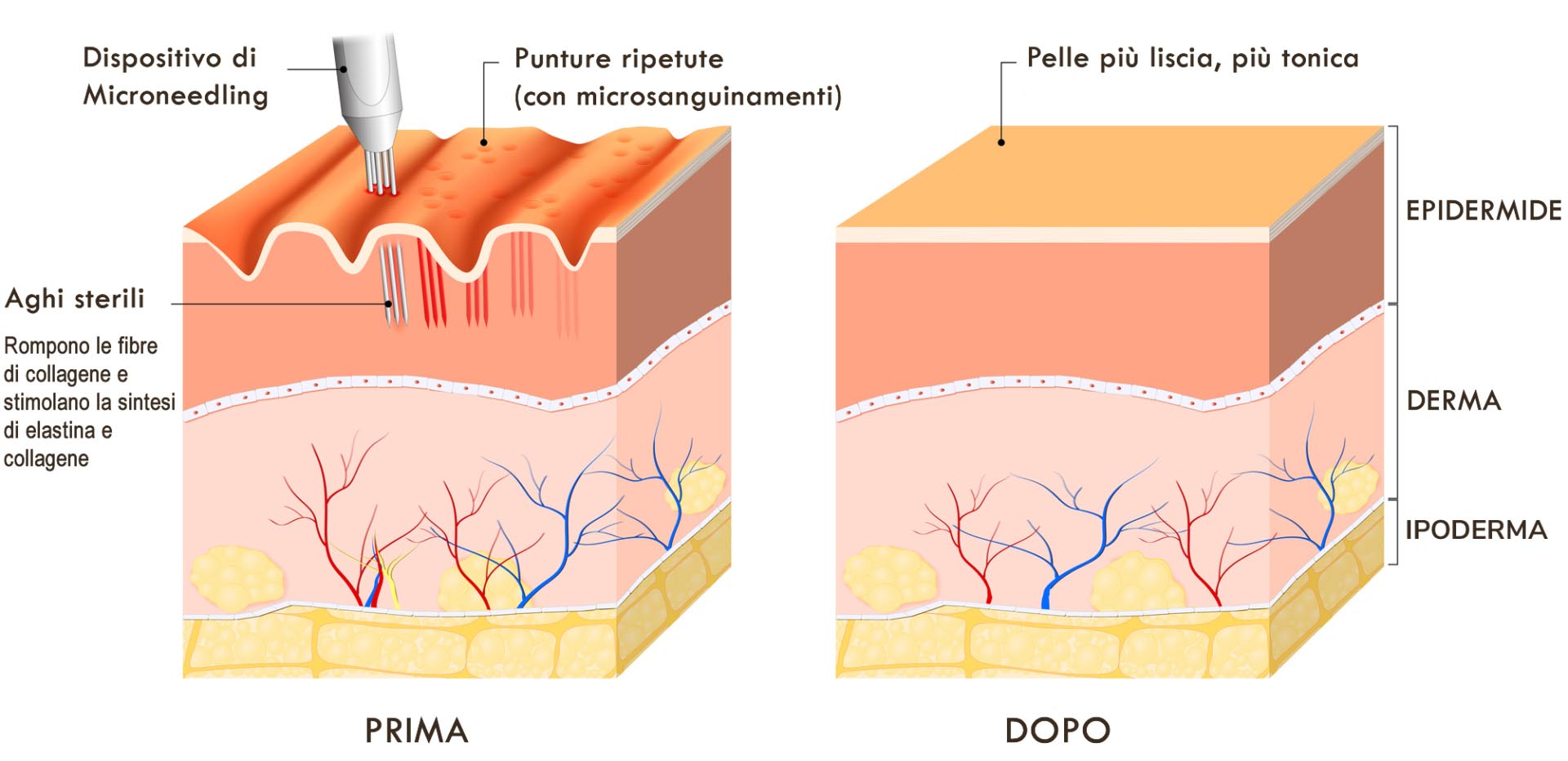 microneedling come funziona