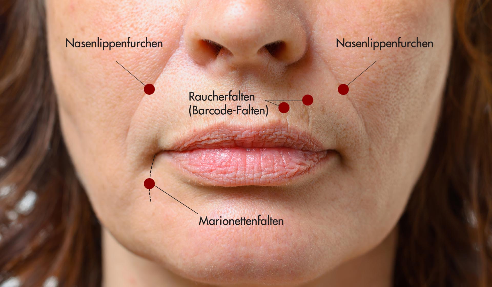 Nasenlippenfurchen