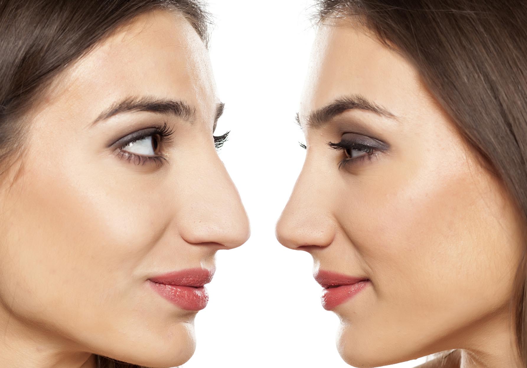 Rhinoplastie