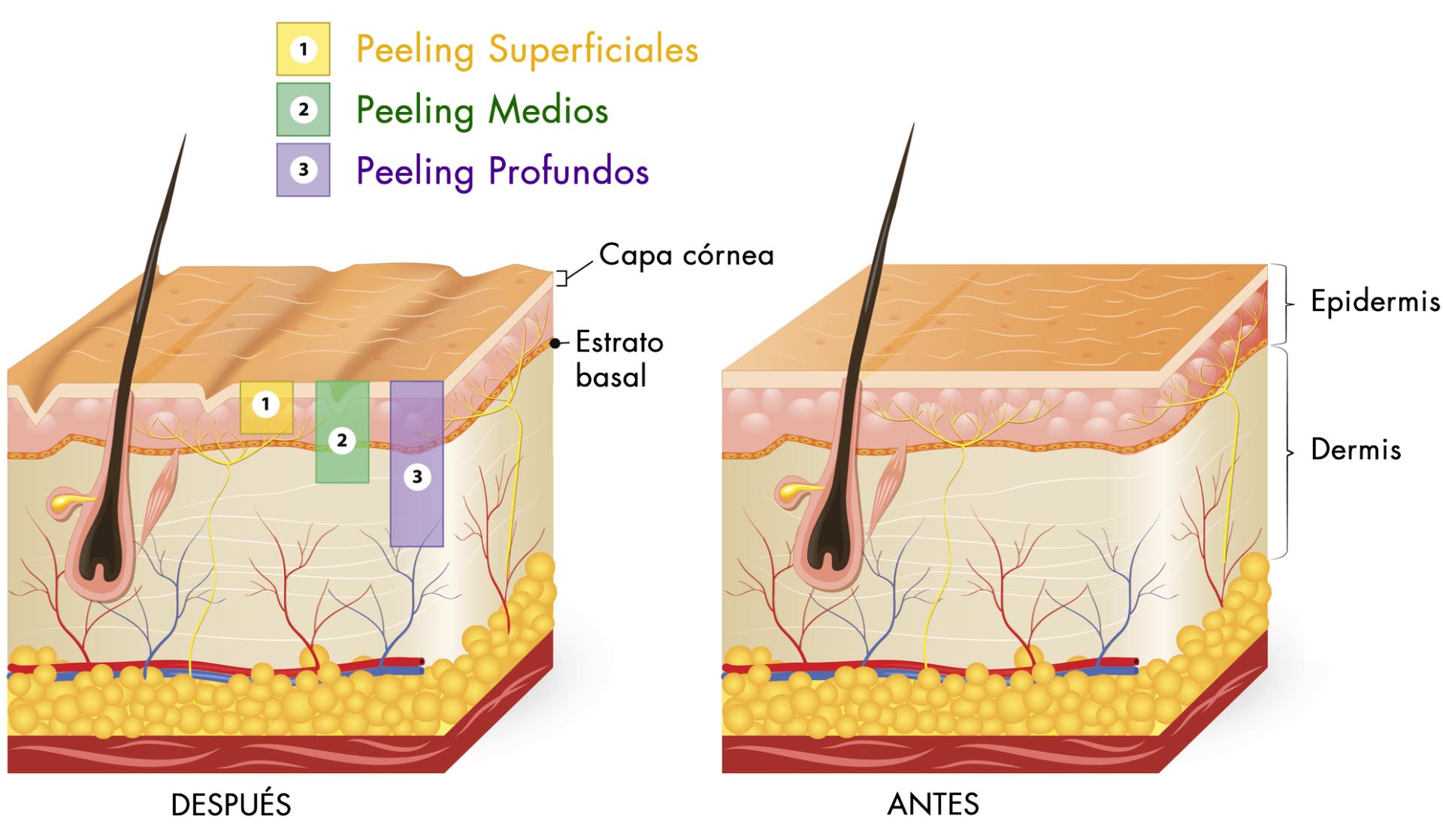 tipos de peeling