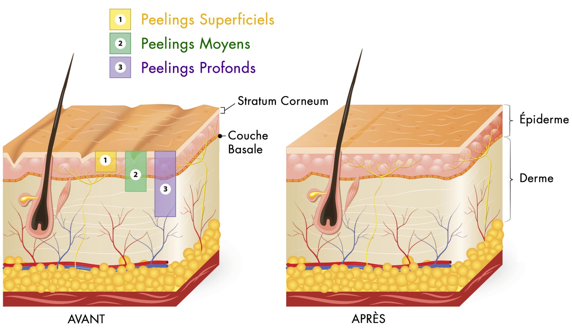 types de peeling