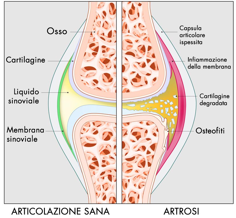 Artrosi