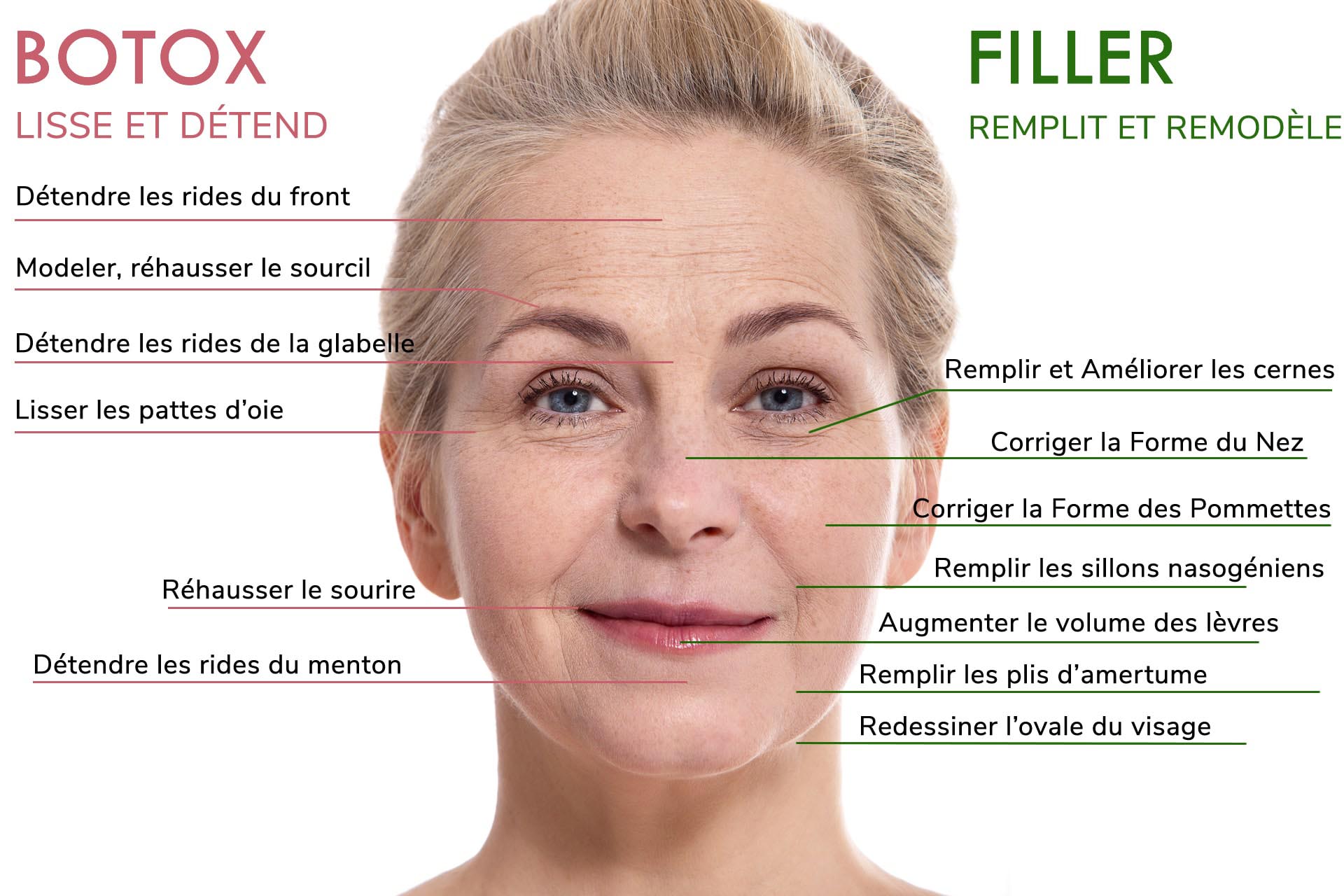 différences botox filler