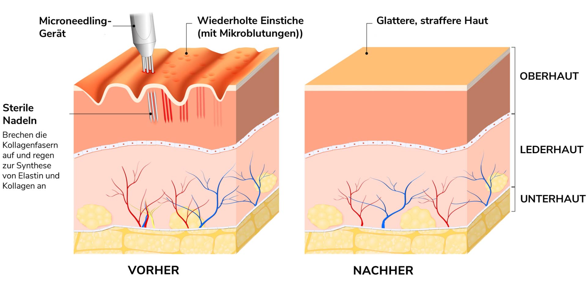 microneedling