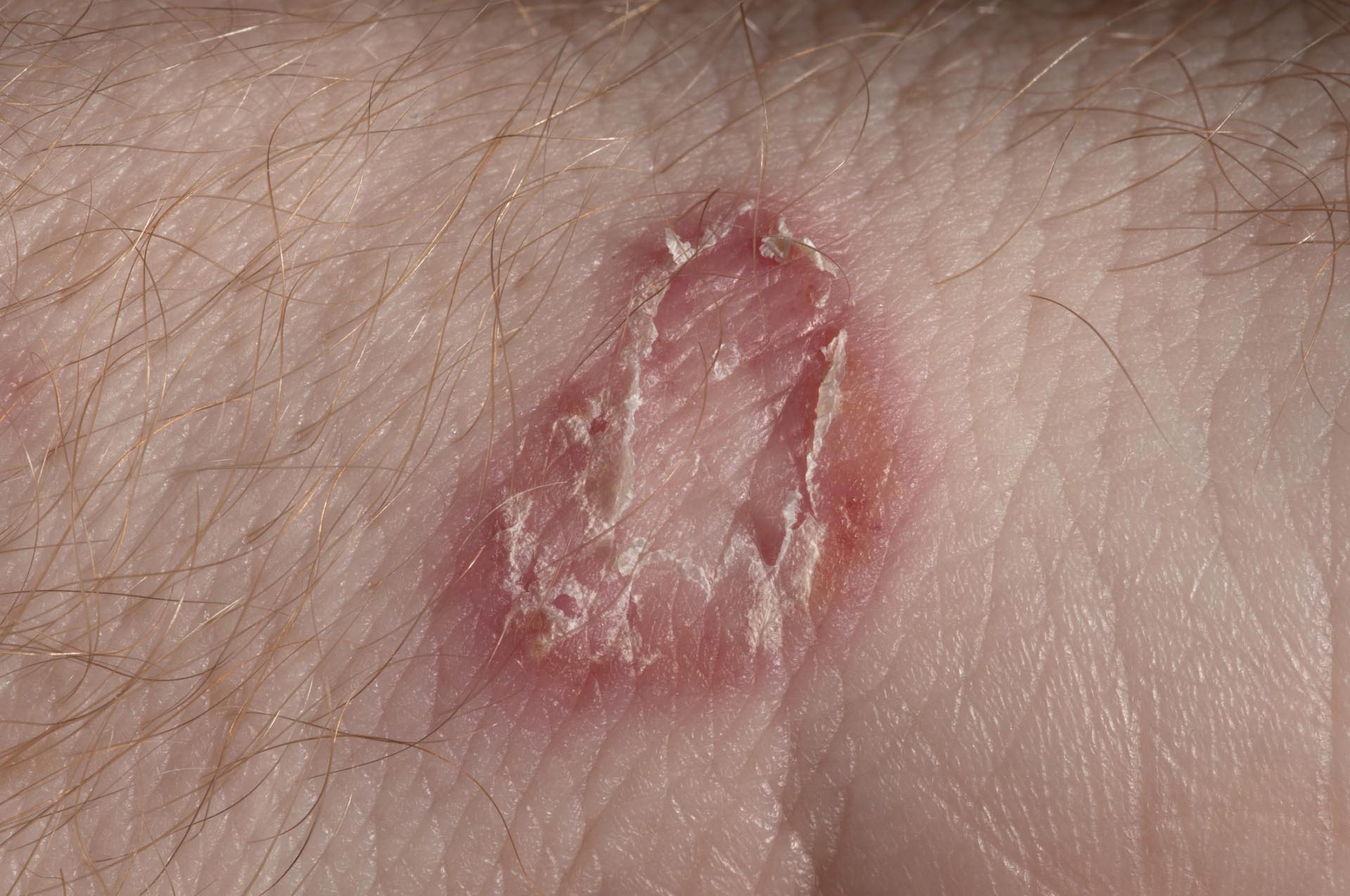 Tinea corporis