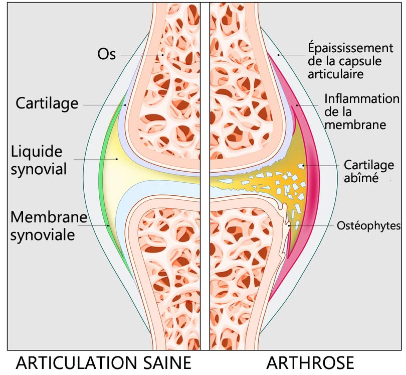 arthrose