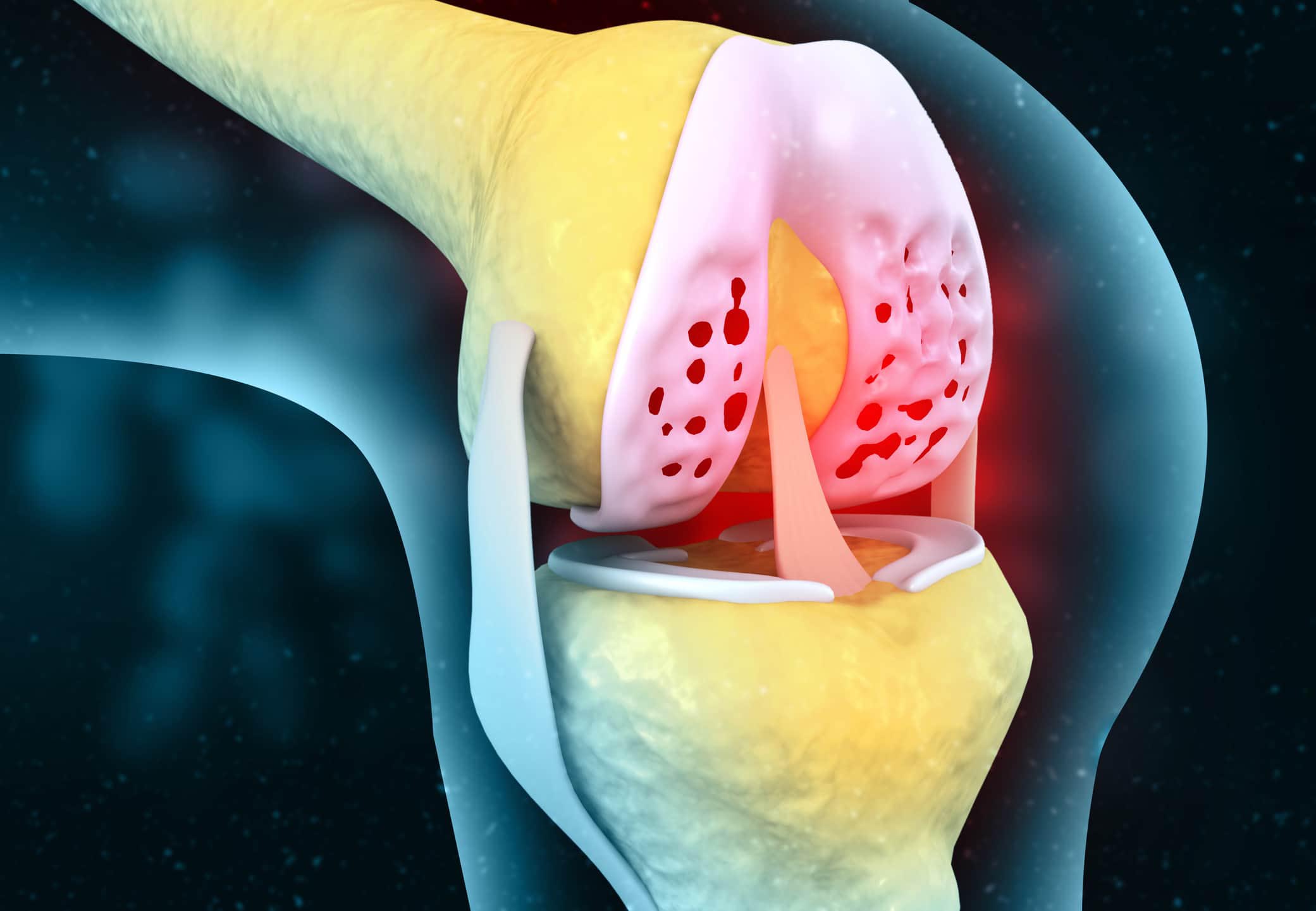 Condroitina - condroitin solfato