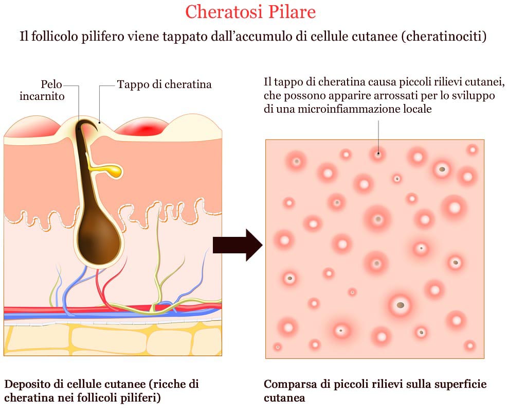 Cheratosi pilare cause