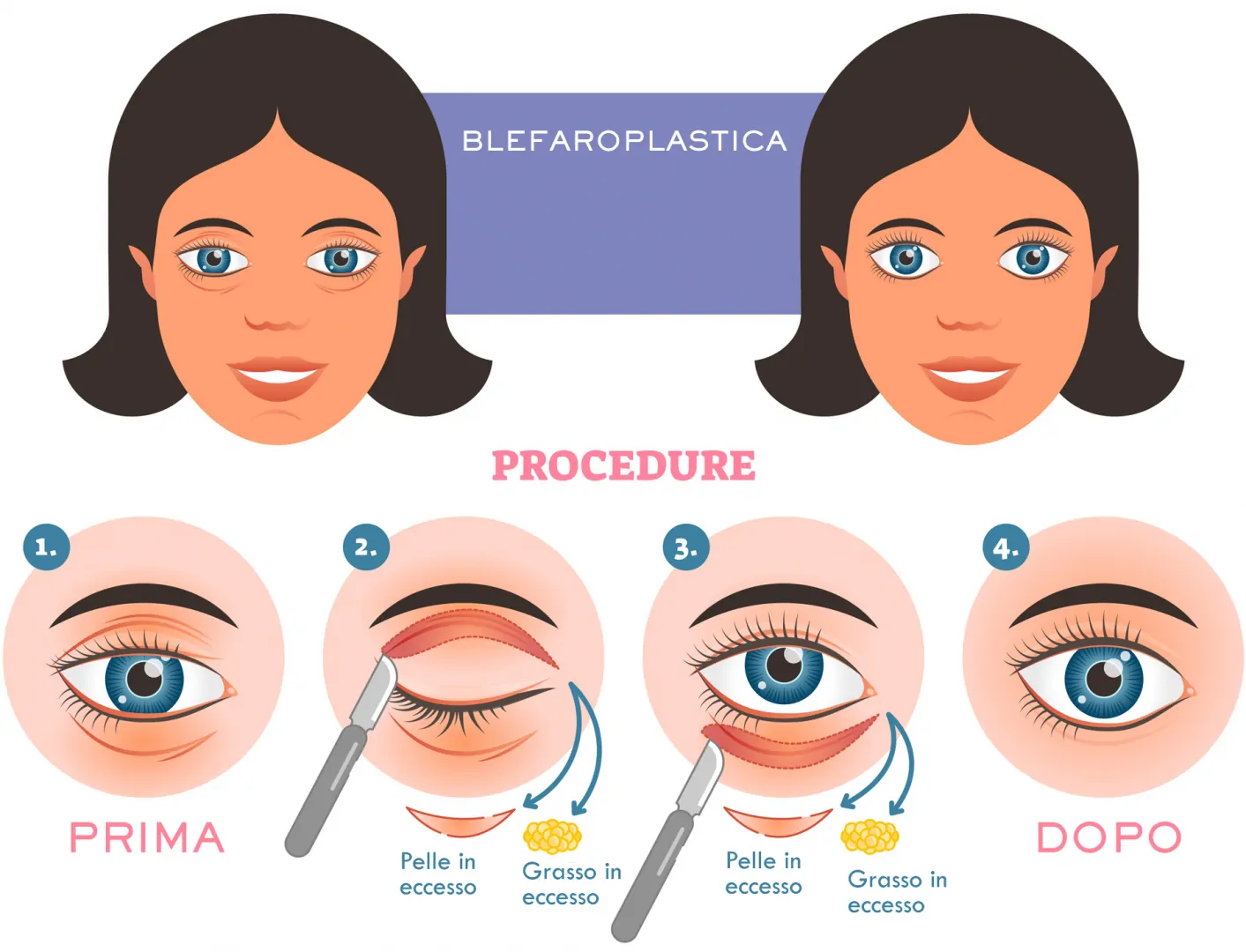 Blefaroplastica Procedura