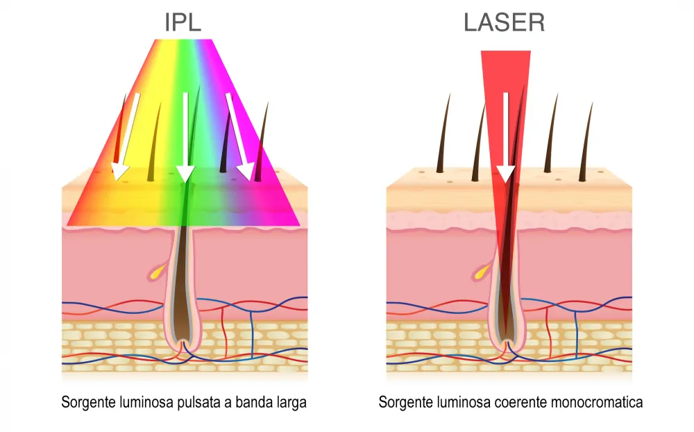 Laser Luce Pulsata