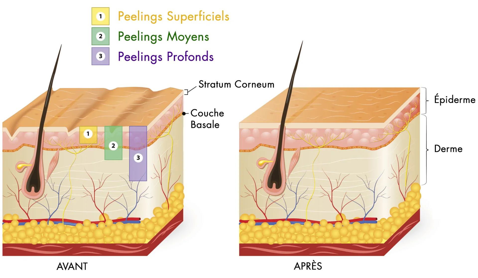 types de peeling