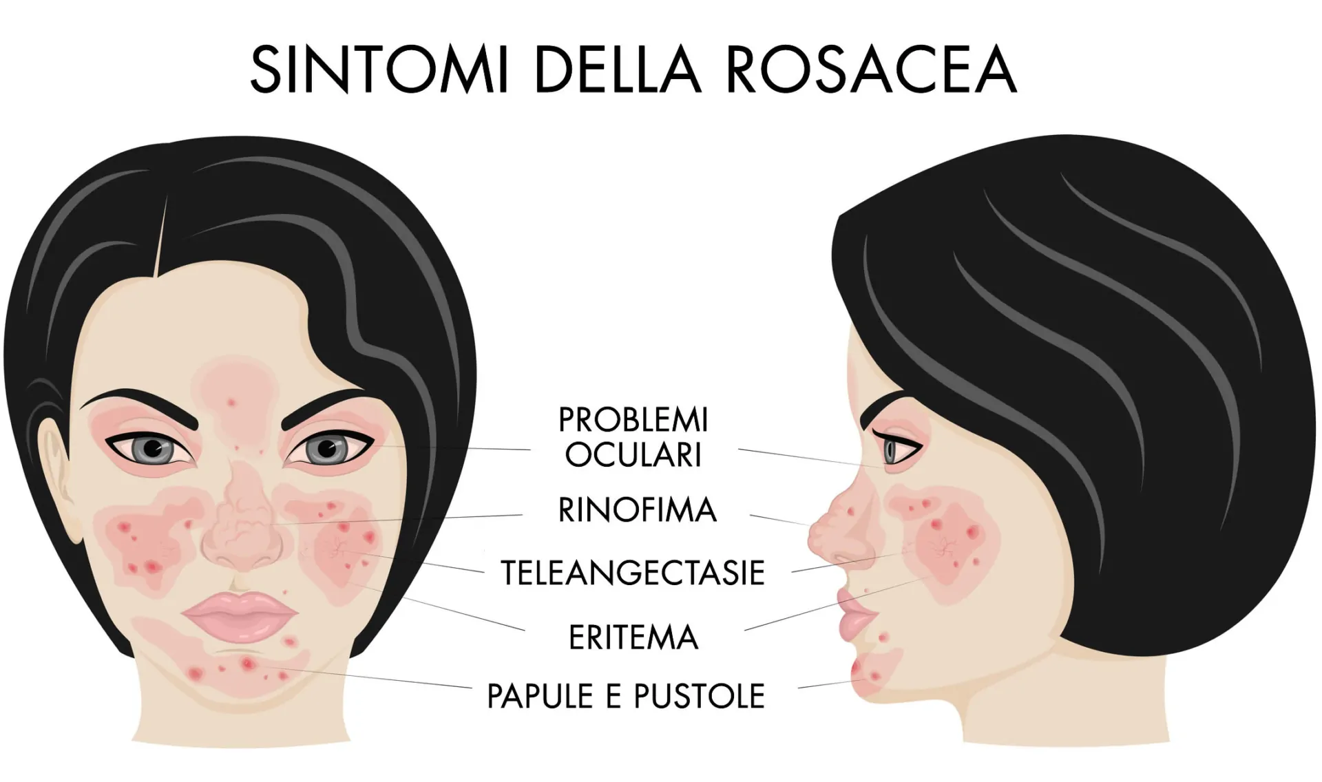 Sintomi Rosacea