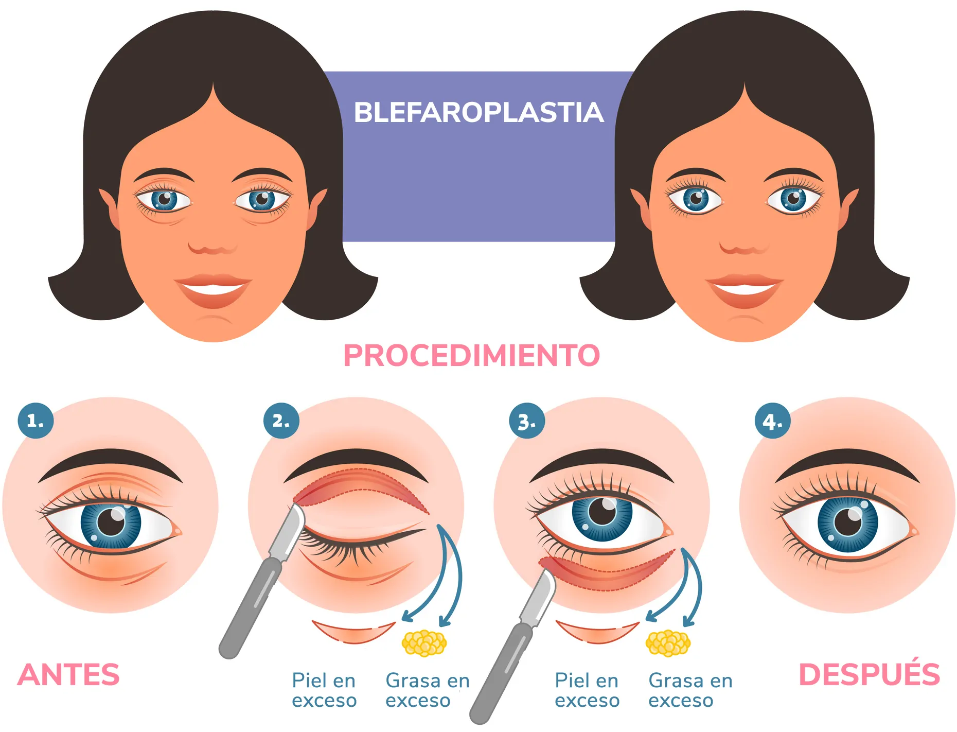 blefaroplastia