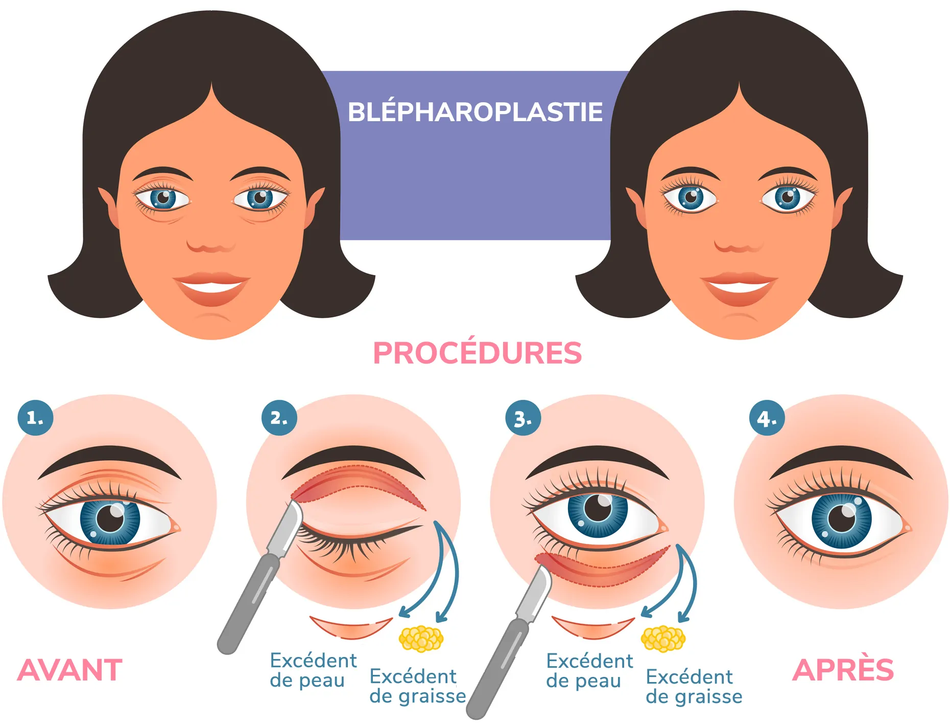 blepharoplastie