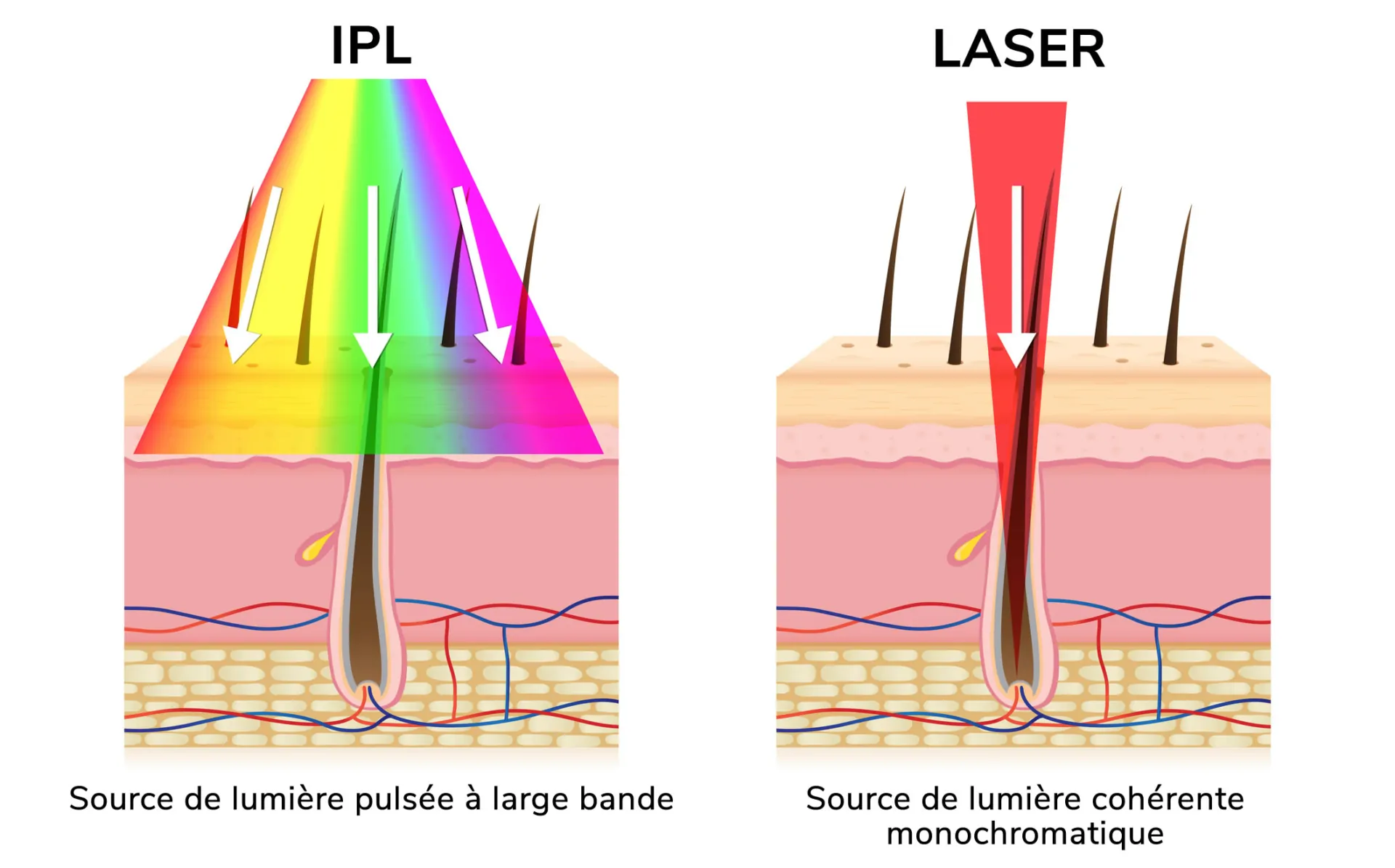 lumière pulsée