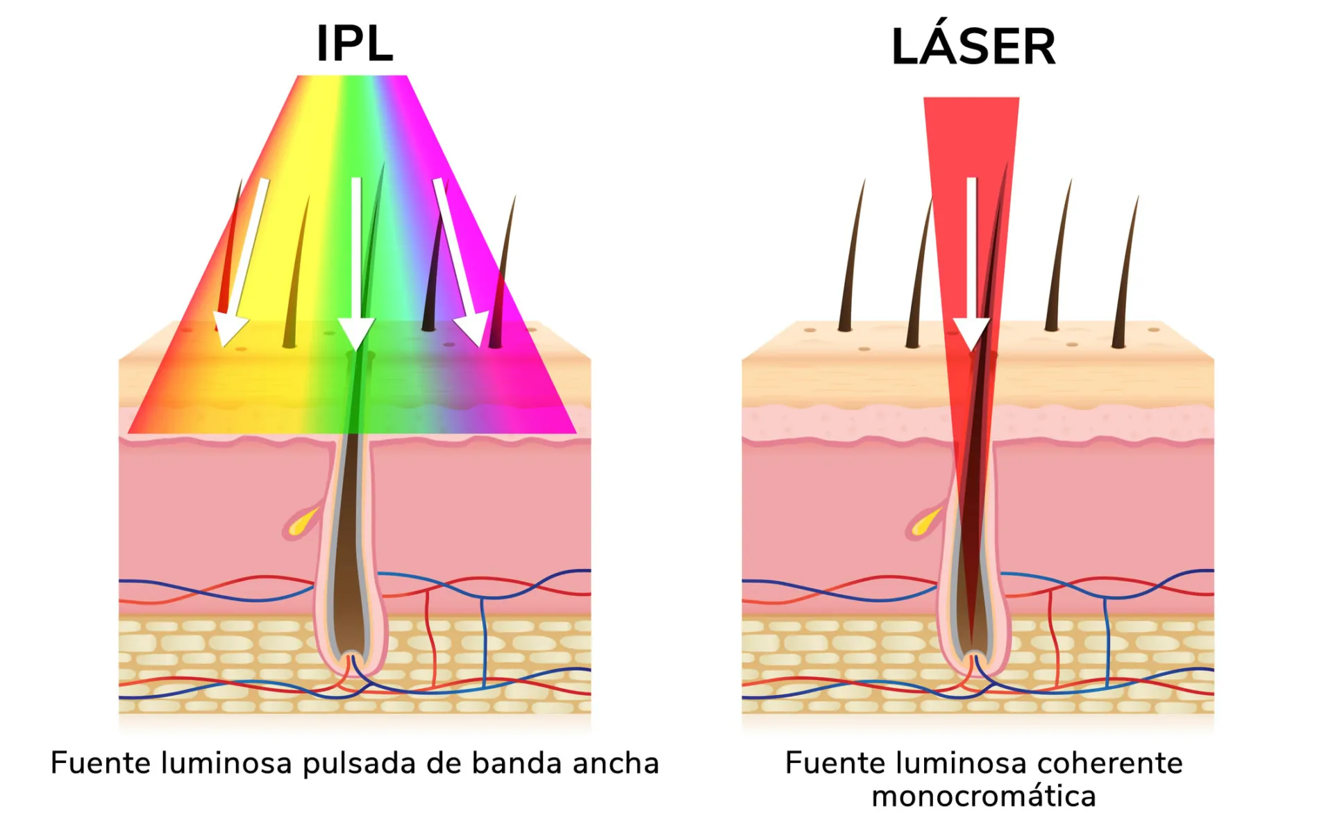 láser y luz pulsada