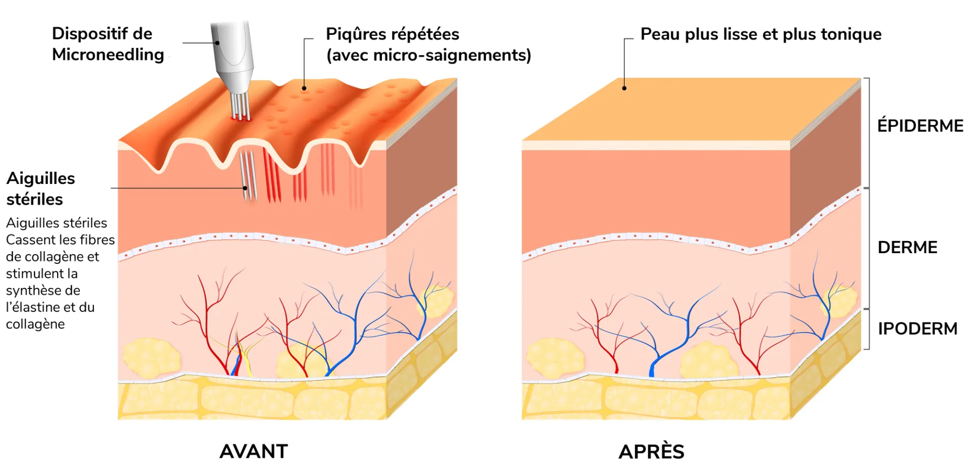 Microneedling