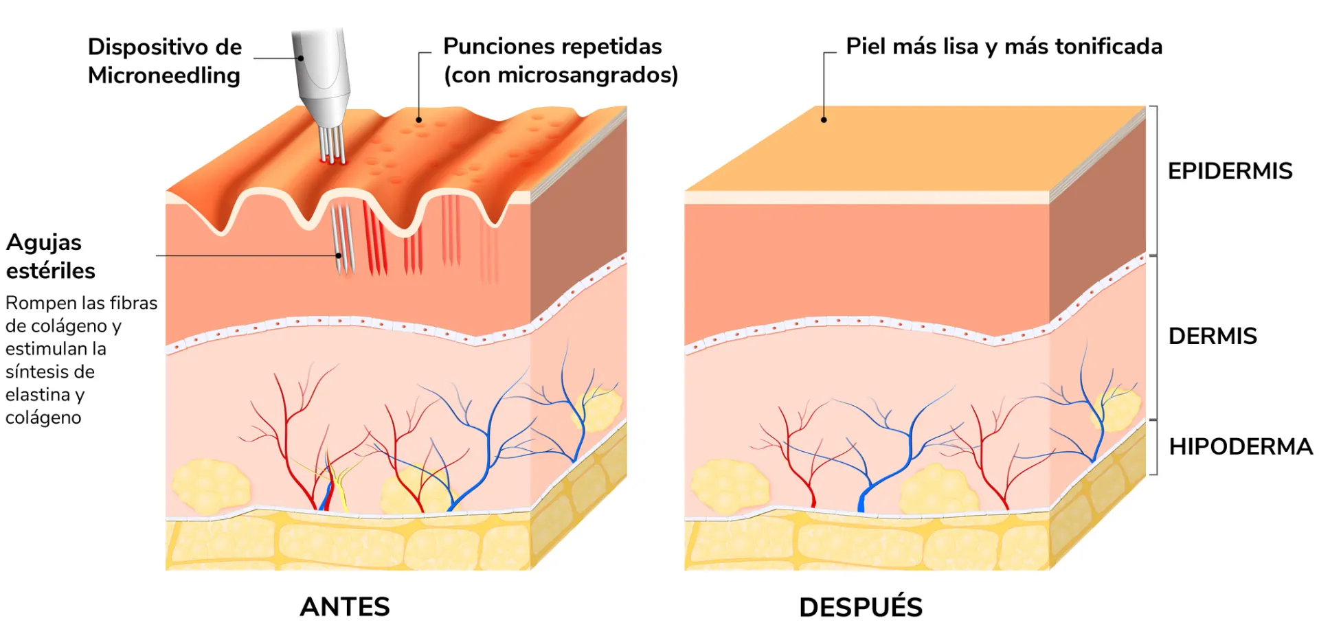 Microneedling cómo funciona