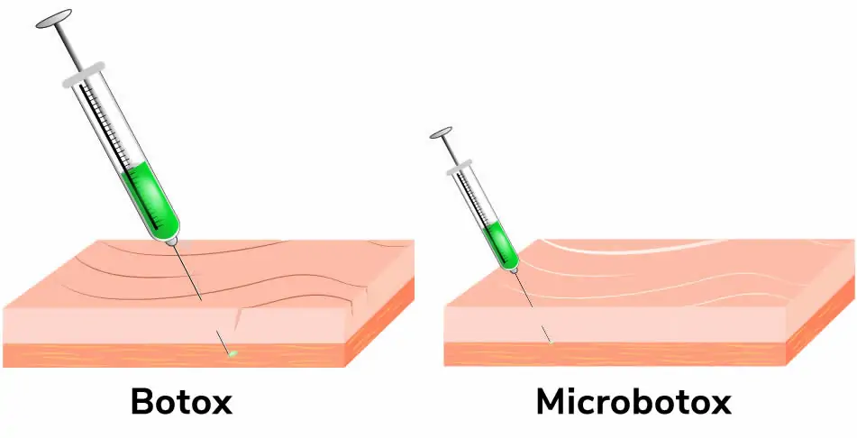 Microbotox