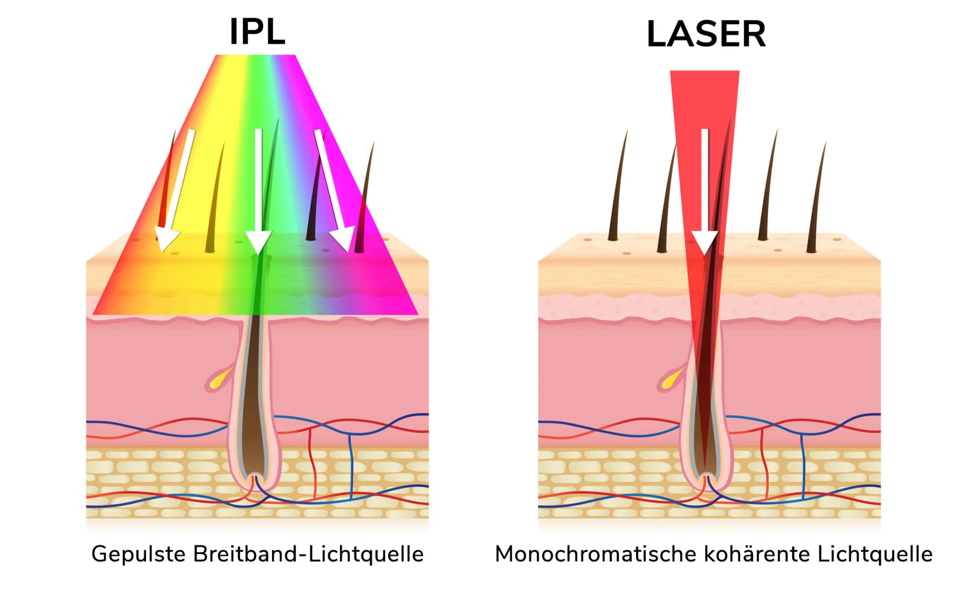 Pulslichttherapie