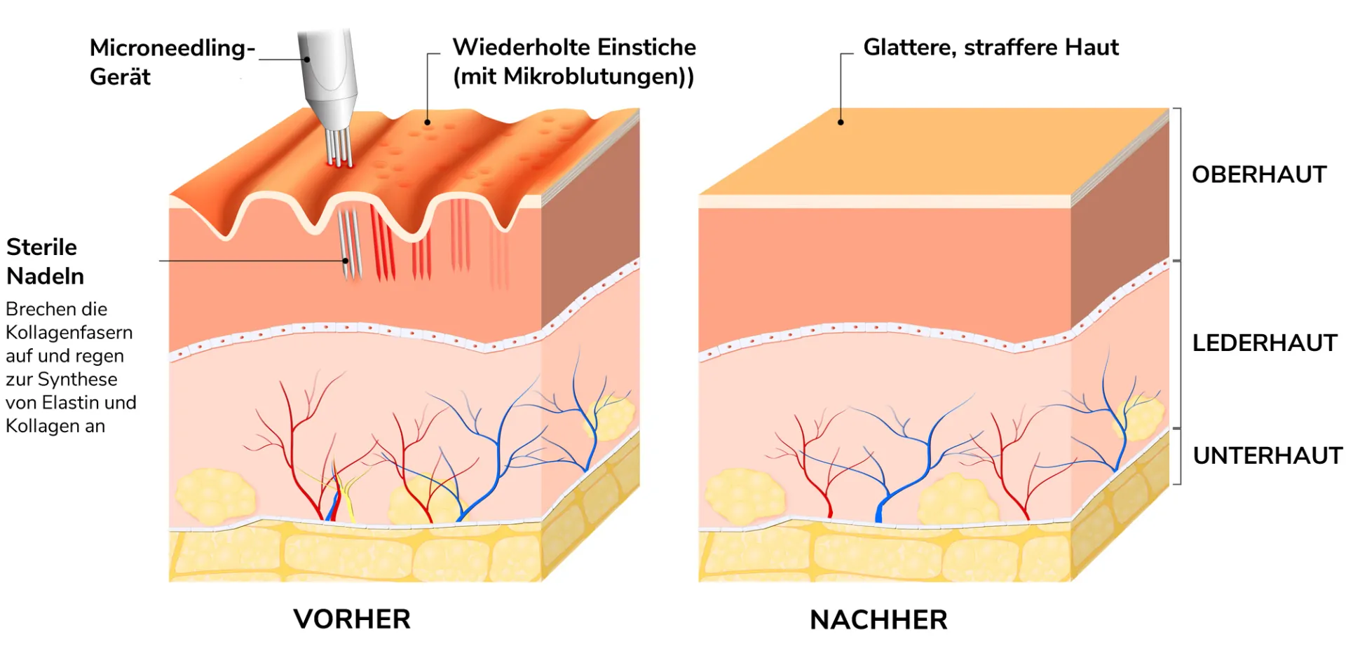 microneedling