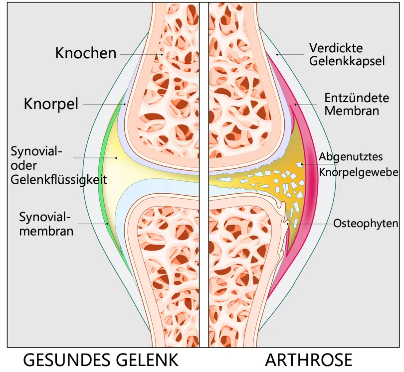 Arthrose