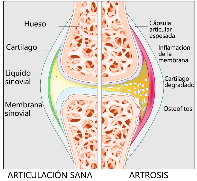 artrosis