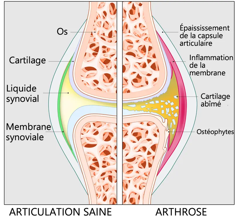 arthrose